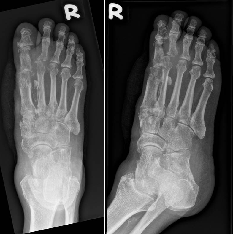 Infection of tophaceous nodule – Radiology Cases