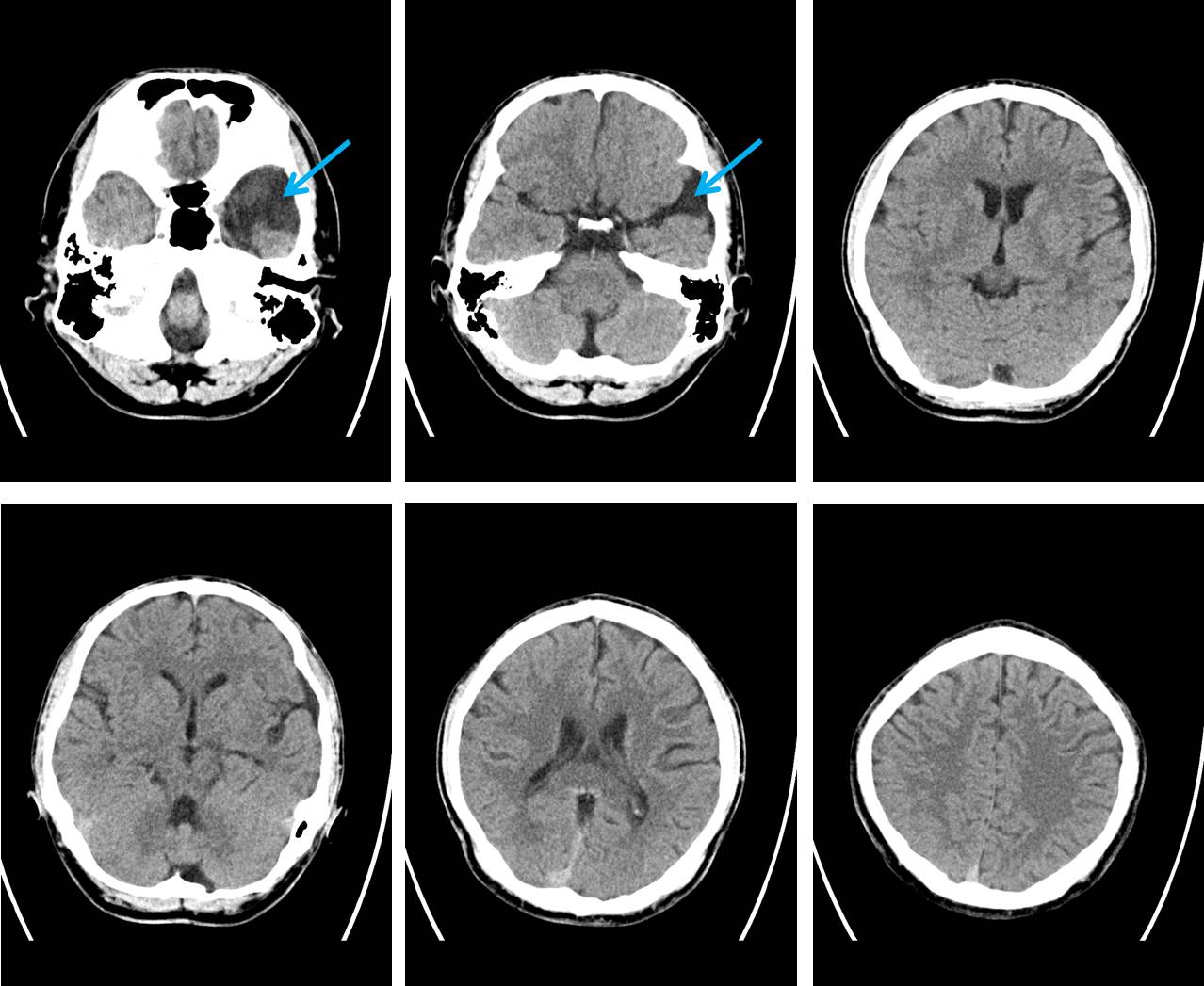 Arachnoid Cyst With Spontaneous Intracystic And Subdural Hemorrhage Radiology Cases 7825