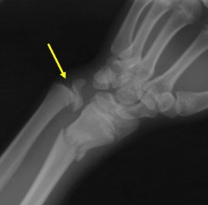 Salter-Harris fracture Type I – Radiology Cases