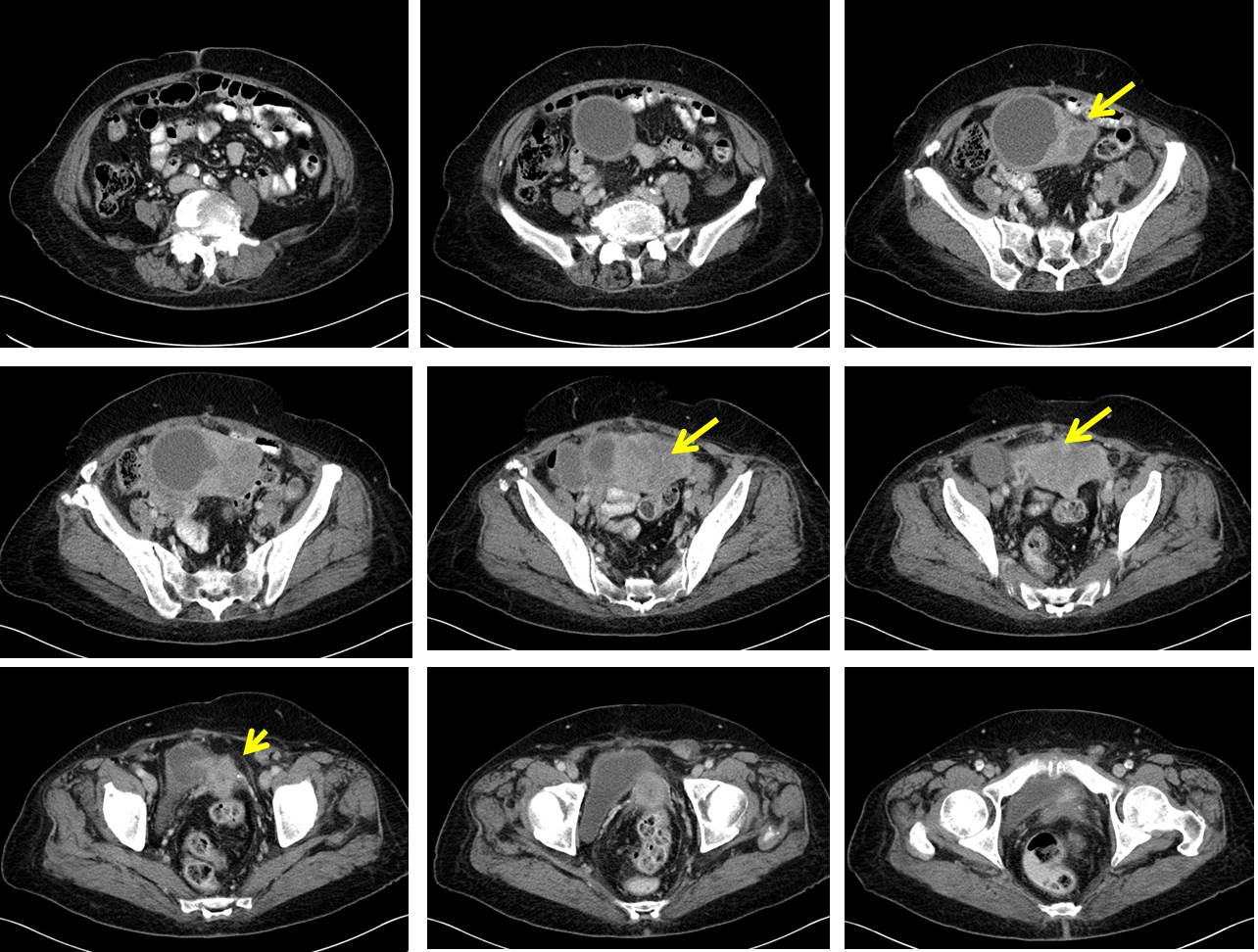 case study on uterine cancer