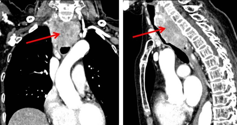 Metastatic papillary thyroid carcinoma – Radiology Cases