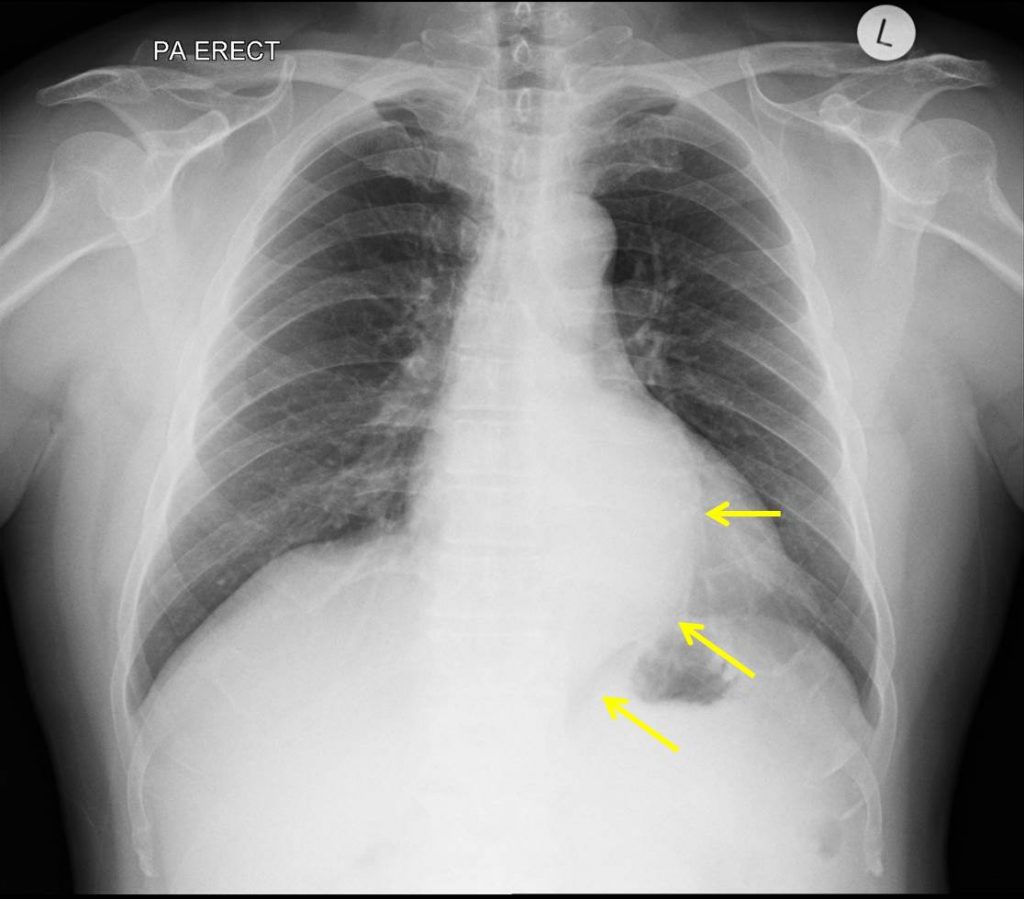 Thoracic Aortic Aneurysm Radiology Cases