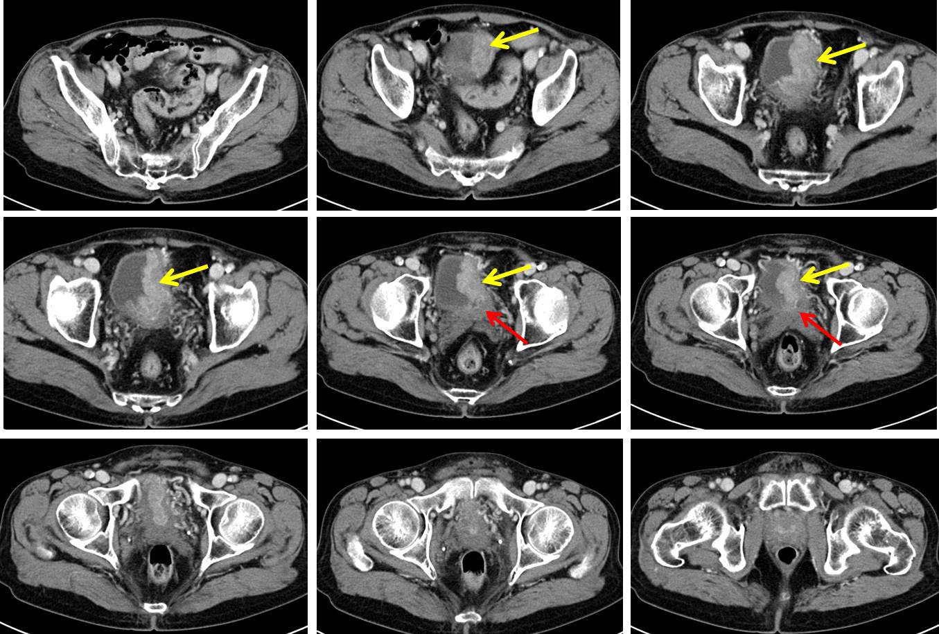 Urinary Bladder Carcinoma Radiology Cases 3680