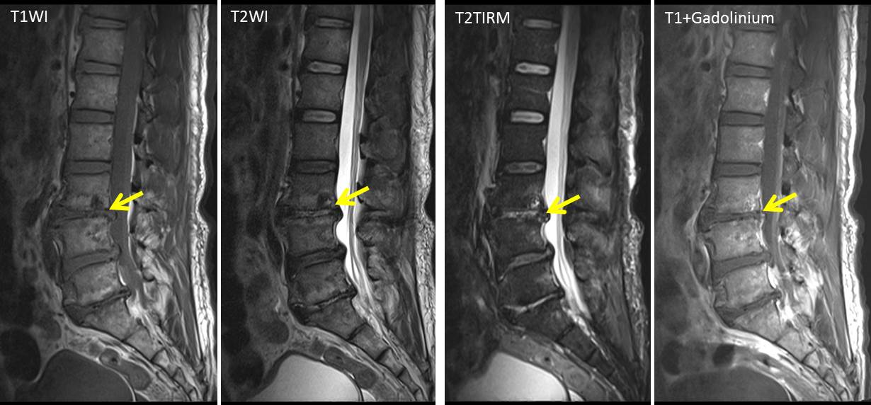 Pyogenic spondylodiscitis with paraspinal abscess Radiology Cases