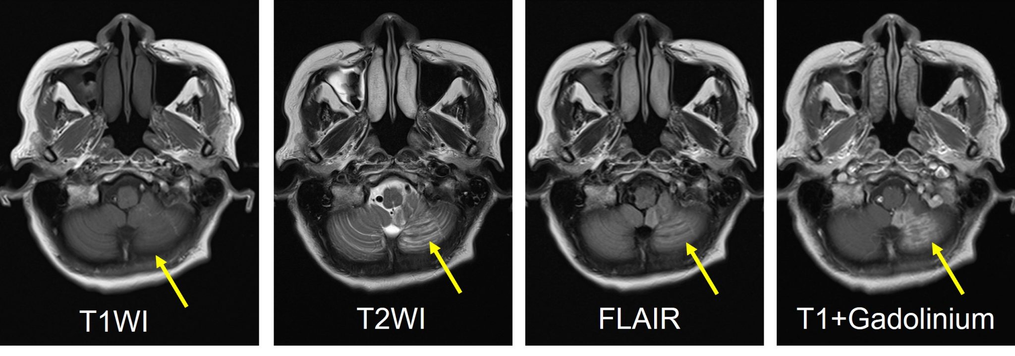 PICA infarction – Radiology Cases