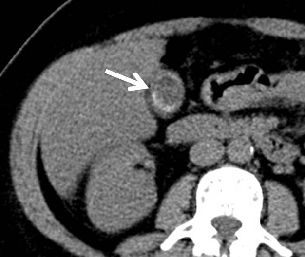 Porcelain Gallbladder Radiology Cases