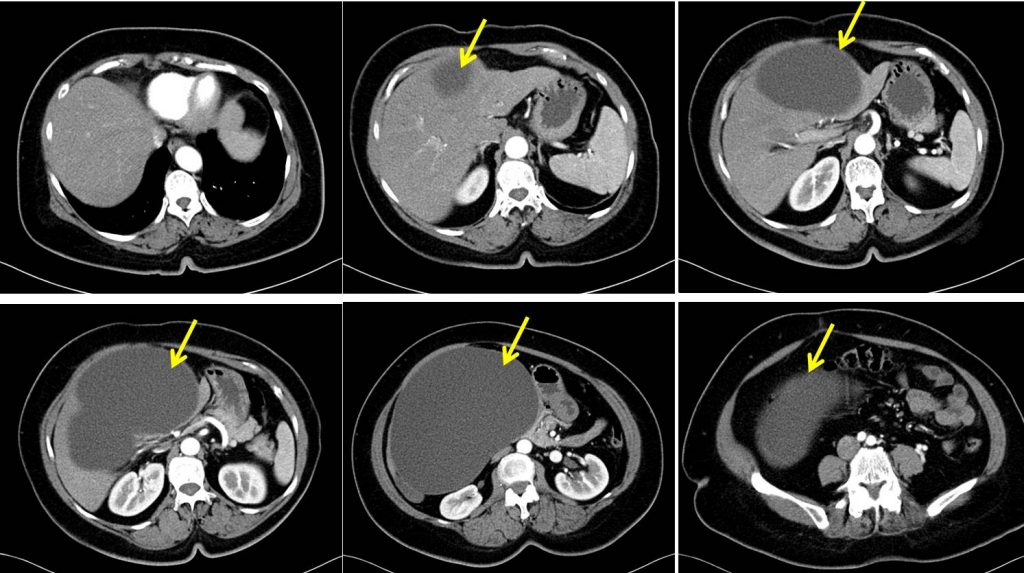 What Is Secondary Malignant Neoplasm Of Liver