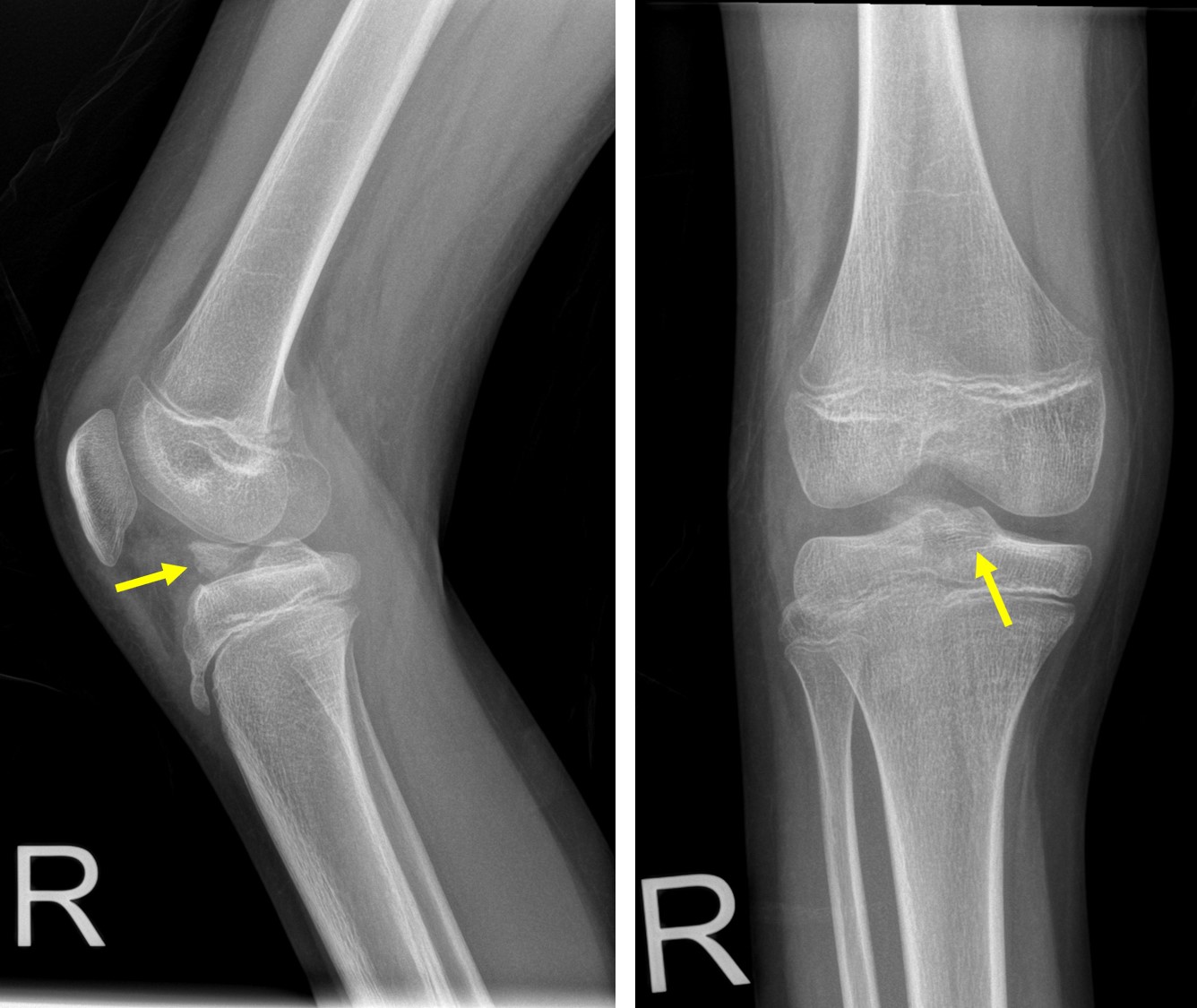 Avulsion Fracture Of ACL – Radiology Cases