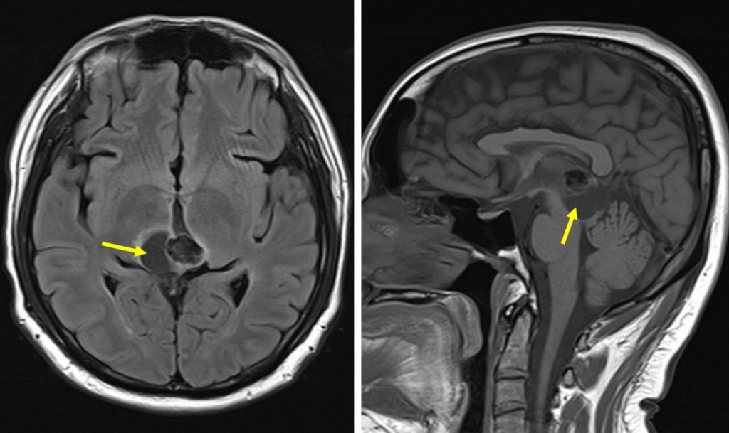 pineal-parenchymal-tumour-of-intermediate-differentiation-radiology-cases