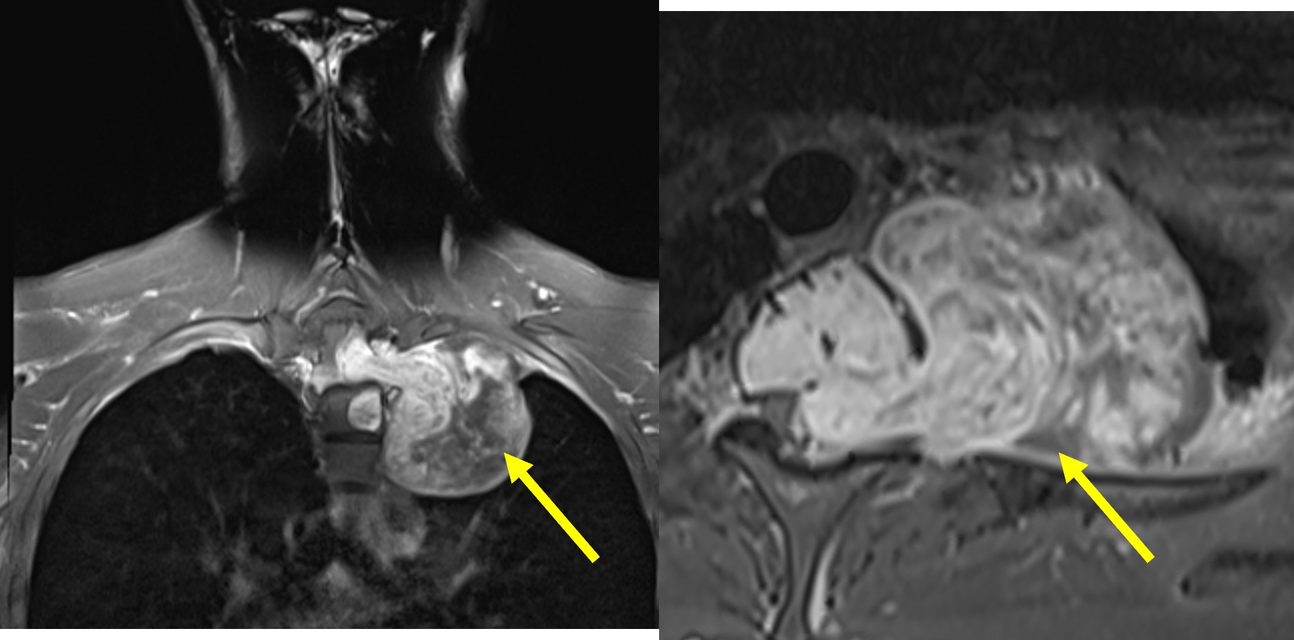 Spinal Schwannoma Radiology Cases